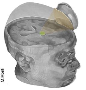 The sounds waves from the ultrasound were focused directly into the thalamus region which is in the center of the brain.